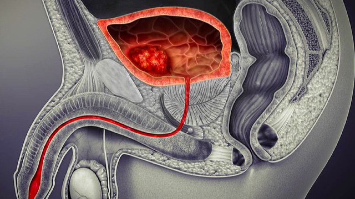 Best Prostate Gland Surgery Doctors in dhaka.