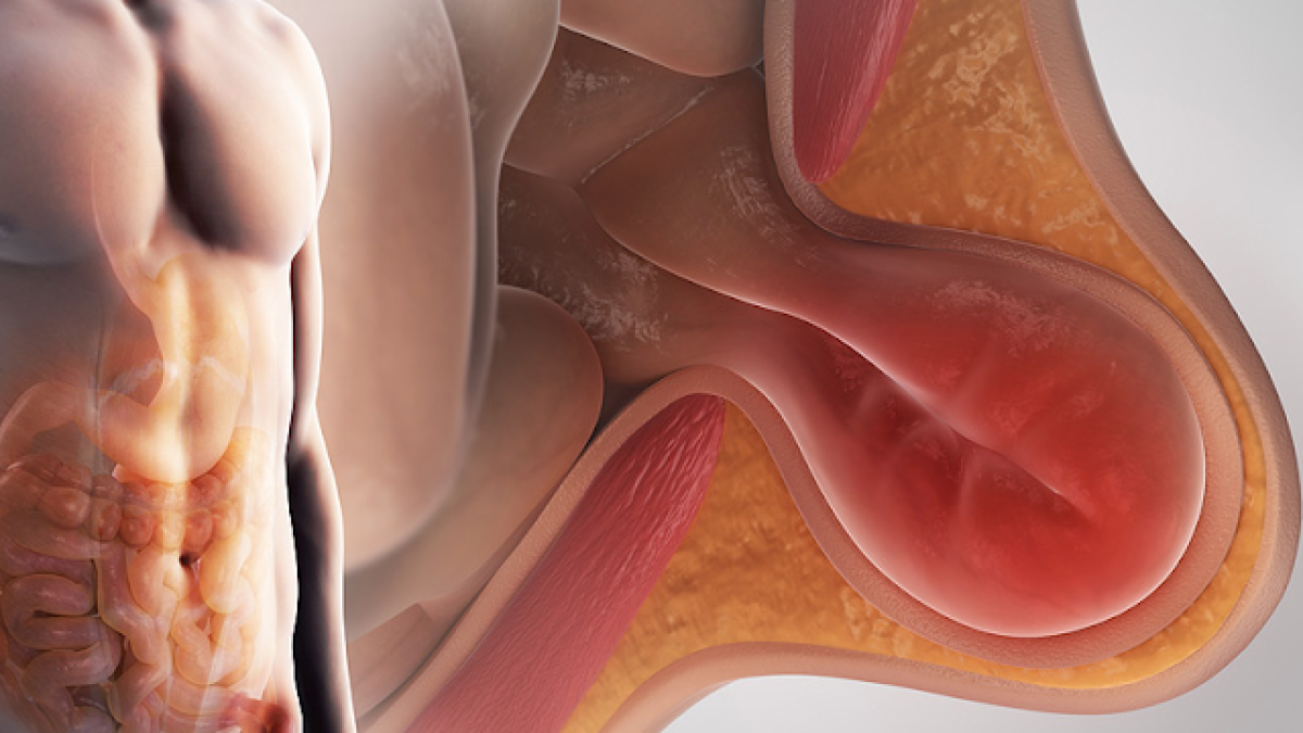 Best Hernia Surgeon in Dhaka.