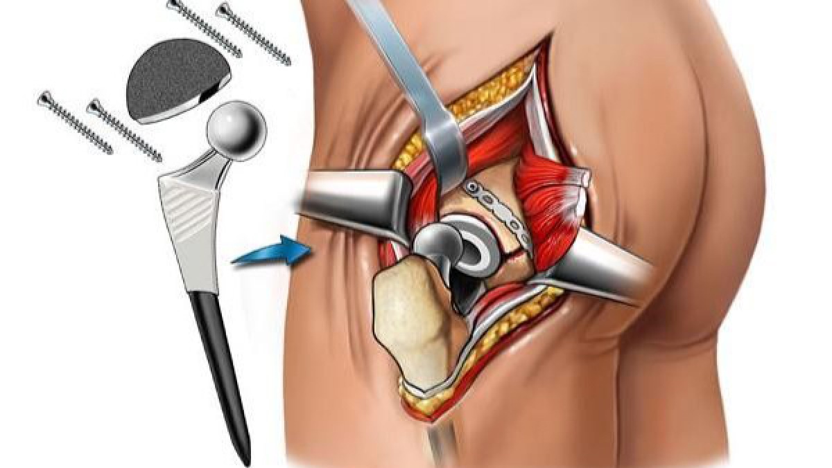 Best Hip replacement Surgeon in Dhaka.